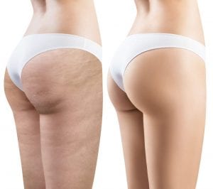 get rid of cellulite